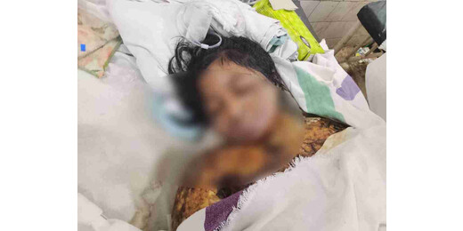 ससुराल में जलायी गई महिला की एसकेएमसीएच में मौत, पुलिस पर लापरवाही का आरोप