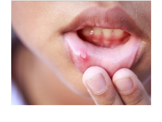 बार-बार मुंह में हो रहे छाले पित्त असंतुलन का संकेत, अनदेखी पड़ सकती है भारी 