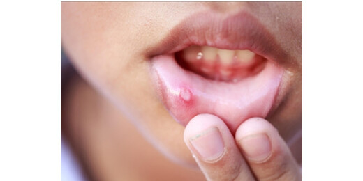 बार-बार मुंह में हो रहे छाले पित्त असंतुलन का संकेत, अनदेखी पड़ सकती है भारी 